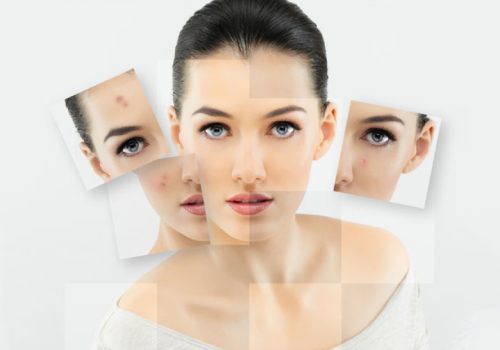 Home Remedies For Acne