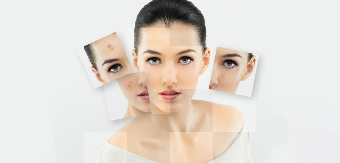 Home Remedies For Acne